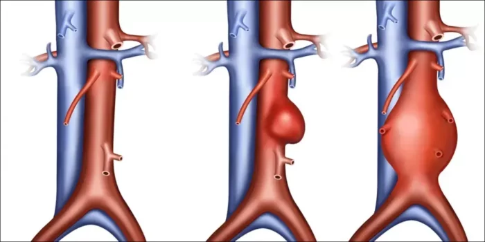 Aortic Aneurysm