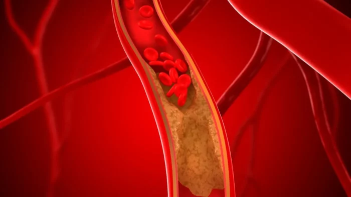 peripheral artery disease