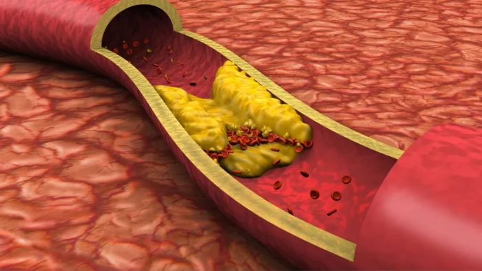 Atherosclerosis