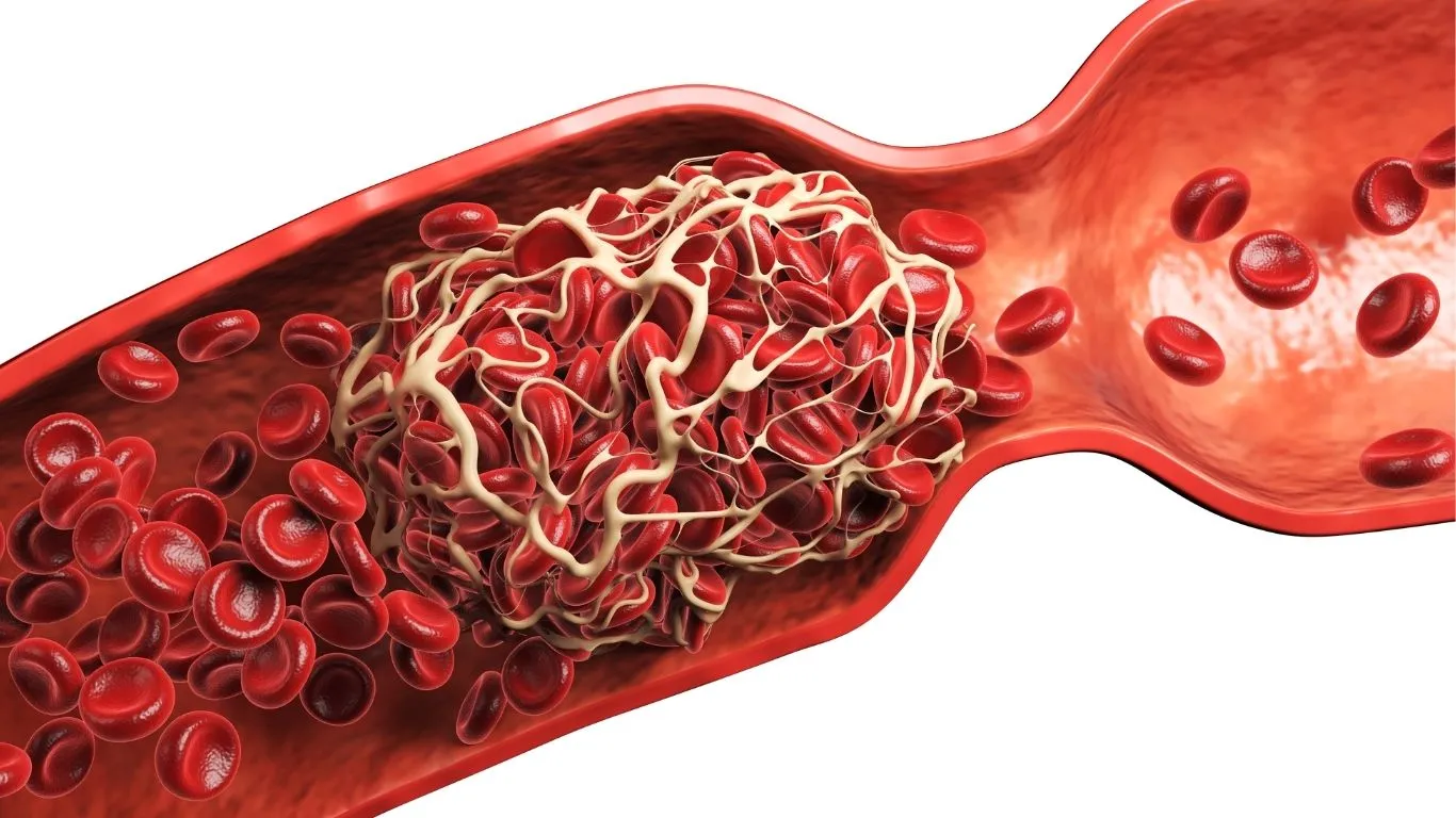 Carotid Artery Stenosis