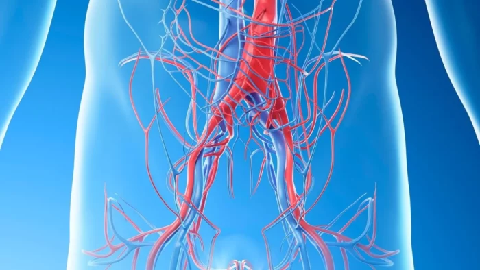 Abdominal Aortic Aneurysm