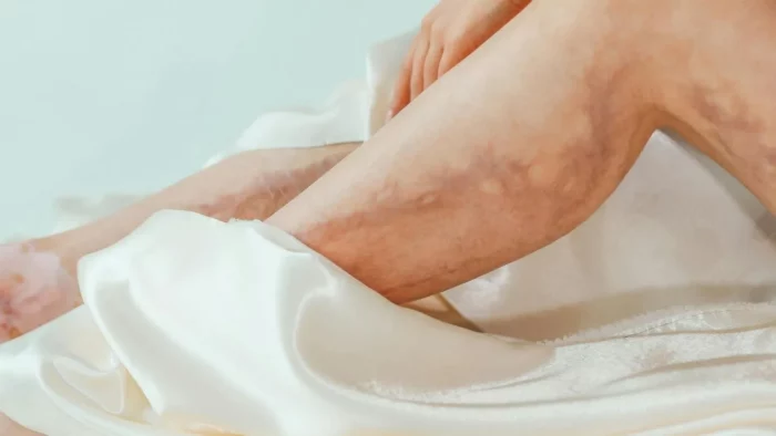 عودة دوالي الساقين بعد العلاج